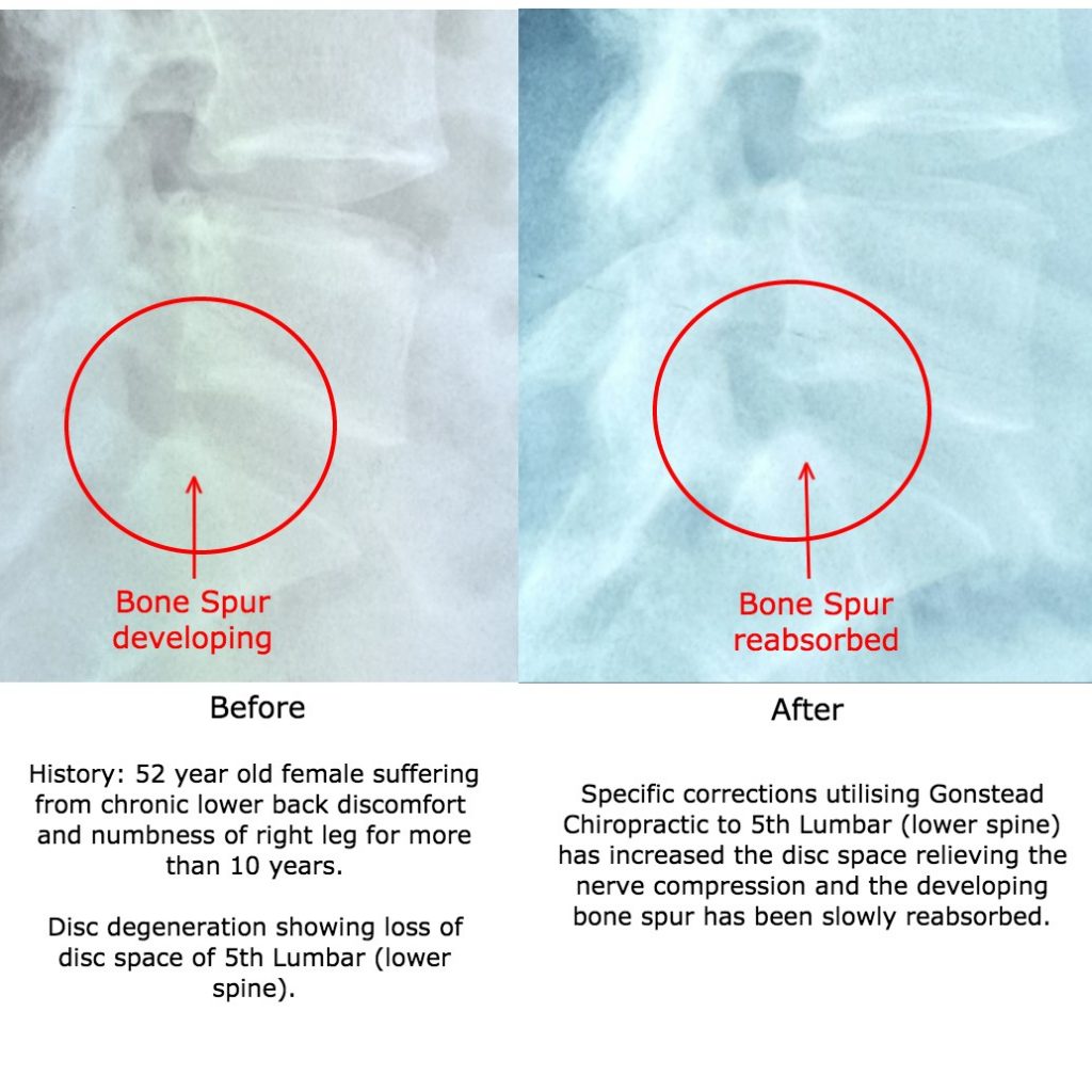 Development of bone spur due to 5th Lumbar Disc Degeneration A
